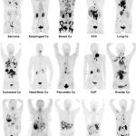 Radiotracer mới có thể xác định gần 30 loại ung thư
