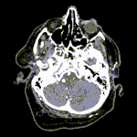Công cụ AI giúp các bác sĩ X quang phát hiện phình động mạch não