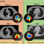 Sử dụng trí tuệ nhân tạo để xác định liệu liệu pháp miễn dịch có hoạt động hay không
