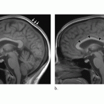 Không gian vũ trụ dài có thể ảnh hưởng đến khối lượng não của phi hành gia
